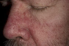 На фото симптомы себорейного дерматита (носощёчные складки)