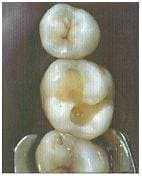 Пломбирование зубов кариозных полостей и корневых каналов 