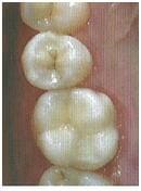 Пломбирование зубов кариозных полостей и корневых каналов 