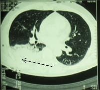 пневмониеподобная форма рака легкого