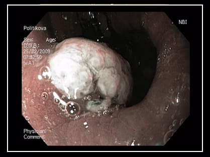 Вид опухоли желудка (рак) в режиме NDI через гастроскоп