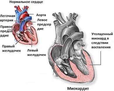 Боль в области сердца