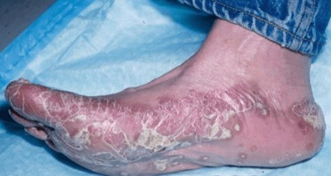 Гиперкератоз кожи подошвы ноги