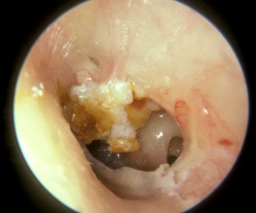 Холестеатома уха лечение народными средствами
